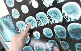 Người bị tai biến sống được bao lâu? Cách sống khỏe mỗi ngày bạn cần biết