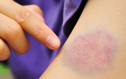 7 dấu hiệu cảnh báo cơ thể bạn thiếu Vitamin C trầm trọng, bổ sung ngay những thực phẩm này!