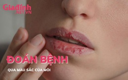 Đoán bệnh qua màu sắc của đôi môi