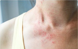 Tự ti vì da nổi mụn, mẩn đỏ trông ‘bẩn bẩn’ hậu COVID-19, nhiều chị em chữa sai cách khiến tình trạng nặng thêm