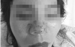 Chi gần triệu tiêm filler thử xem có hợp, hỏng thật cả mũi, mặt