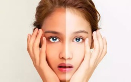 Cách chữa làn da bị cháy nắng hiệu quả nhất tại nhà