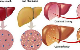 Cách ngăn ngừa gan nhiễm mỡ ở người bệnh đái tháo đường