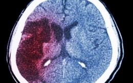 Xuất huyết não “giết người nhanh nhất”, 4 dấu hiệu trước khi khởi phát nhưng dễ bị bỏ qua