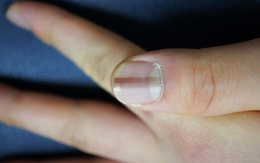 Móng tay xuất hiện đặc điểm này, bạn cần tới bệnh viện ngay