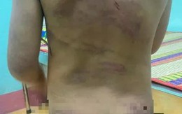 Bé gái nghi bị bạo hành với nhiều vết thương chi chít trên cơ thể