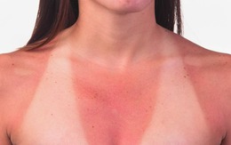 Cách chăm sóc da khi bị cháy nắng