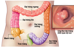 6 dấu hiệu sớm cảnh báo ung thư trực tràng, đáng tiếc là nhiều người ngại khám và bỏ qua!