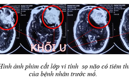 Thường xuyên mệt mỏi, đau đầu, mắt nhìn mờ, thai phụ rơi vào hôn mê, đe dọa tính mạng