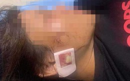 Thanh Hoá: Xác minh thông tin người phụ nữ bị thương nghi do súng bắn