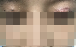 Cắt mí mắt ở cơ sở thẩm mỹ "chui", một phụ nữ bị hỏng mắt