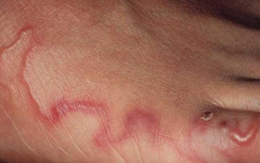 Đã bao lâu bạn không tẩy giun? Đừng chủ quan vì đây có thể là nguyên nhân khiến bạn bị thiếu máu!