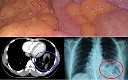 Hy hữu: Đi khám hậu Covid-19, nam thanh niên phát hiện đại tràng chui ngược lên ngực
