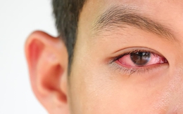 Thanh niên trẻ hốt hoảng khi phát hiện bệnh lậu ở... mắt