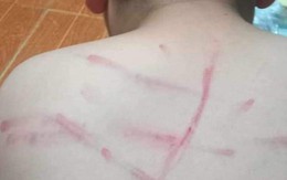 Thanh Hóa: Học sinh bị cô giáo đánh bầm tím lưng vì không làm bài tập