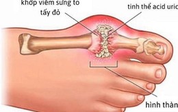 Phòng bệnh gout tái phát bằng món ăn bài thuốc đơn giản tại nhà