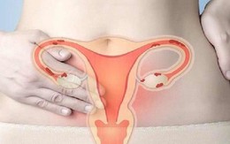4 dấu hiệu chính cảnh báo ung thư cổ tử cung không nên bỏ qua
