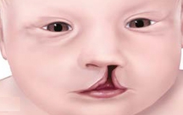 Dị tật bẩm sinh sứt môi - hở hàm ếch xảy ra ở giai đoạn nào của thai kỳ?