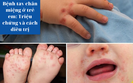 Bệnh tay chân miệng ở trẻ em: Triệu chứng và cách hỗ trợ cải thiện