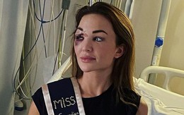 Gương mặt biến dạng của Hoa hậu Bỉ sau tai nạn xe hơi