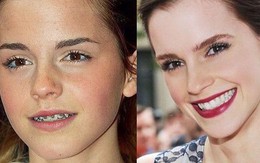 Bí kíp để có nụ cười “hút fan” như sao Hollywood