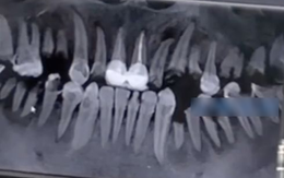 Chàng trai 23 tuổi răng bị ăn mòn, gãy gần hết cả hàm vì loại đồ uống giới trẻ không ai là không thích