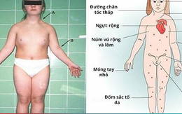Thấy con thấp hơn bạn cùng trang lứa, đưa đi khám phát hiện mắc hội chứng Turner