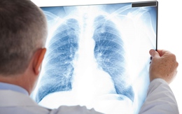 Những ai nên tầm soát ung thư phổi?