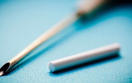 Đau mỗi lần cử động vì que cấy tránh thai 'đi lạc' vào cơ