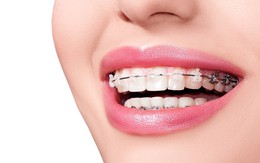 Niềng răng: Phương pháp thẩm mỹ chưa bao giờ hết hot vì tác dụng '2 trong 1'