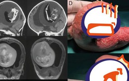 Mang thai đôi nhưng chỉ sinh một bé, 1 năm sau bố mẹ đưa con gái đi khám mới phát hiện sự thật đáng sợ nằm trong não