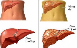 Cơ thể có 1 trong 7 dấu hiệu này chứng tỏ gan của bạn đang 'kêu cứu'