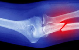 Lý do kỳ lạ và đáng lo ngại khiến xương của chúng ta ngày càng giòn, kể cả ở người trẻ