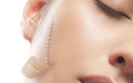 Những điều nên làm để giảm, ngăn ngừa sẹo