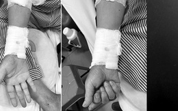 Ngủ dậy bất ngờ tê bì, đau nhức tay, người đàn ông gặp nguy hiểm, suýt phải cắt bỏ bàn tay