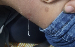 Ổ giun rồng 0,7-1,2 m chui ra từ khối sưng nề trên cơ thể