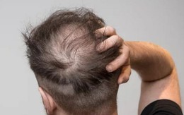 Đi khám vì tóc rụng, người đàn ông bất ngờ phát hiện mắc giang mai