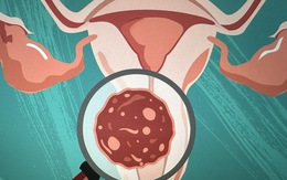 Ung thư cổ tử cung có chữa được không?