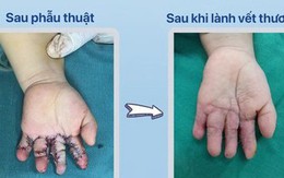 Bệnh viện Sản Nhi Nghệ An phẫu thuật tách thành công 4 ngón tay bị dính bẩm sinh cho trẻ