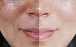 7 loại thực phẩm giúp chậm lão hóa da, ngừa cháy nắng