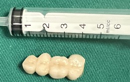 Đỡ cháu trượt ngã, bà bị răng giả chui tọt vào bụng phải đi cấp cứu