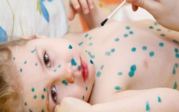 Có nên bôi xanh methylen trị vết loét khi trẻ bị tay chân miệng?