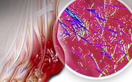 Ý nghĩa việc xét nghiệm acid uric máu và giải pháp khi acid uric tăng