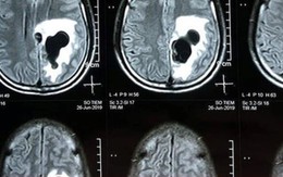 Tưởng bị tâm thần, hóa ra sán làm tổ trong não
