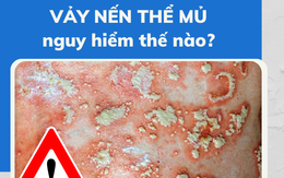 Bệnh vảy nến thể mủ nguy hiểm thế nào?