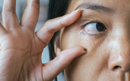 Đột quỵ mắt là gì? Dấu hiệu, nguyên nhân và cách phòng ngừa