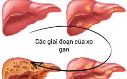 Cơ thể có 6 dấu hiệu này chứng tỏ gan của bạn đang nhiễm bệnh, cần khám gan càng sớm càng tốt!