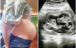 Bà mẹ mang thai hai cặp song sinh cùng lúc, bác sĩ nói 70 triệu ca mới có một