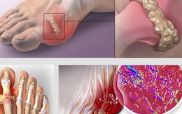 Dấu hiệu nhận biết các giai đoạn và mức độ nguy hiểm của bệnh gout
