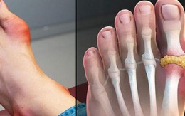 Điều trị bệnh gout cần lưu ý 3 điều sau